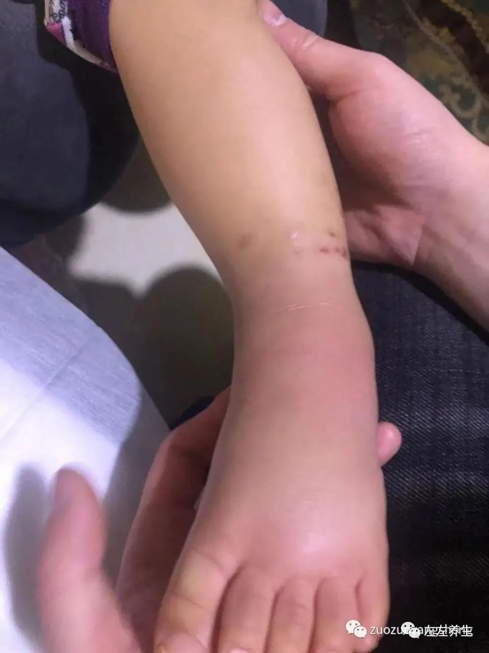 案例分享:原始点调理小孩荨麻疹调理案例 案例分享:原始点调理小孩荨麻疹调理案例