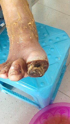 糖尿病脚趾头腐烂后脱落 糖尿病脚趾头腐烂后脱落