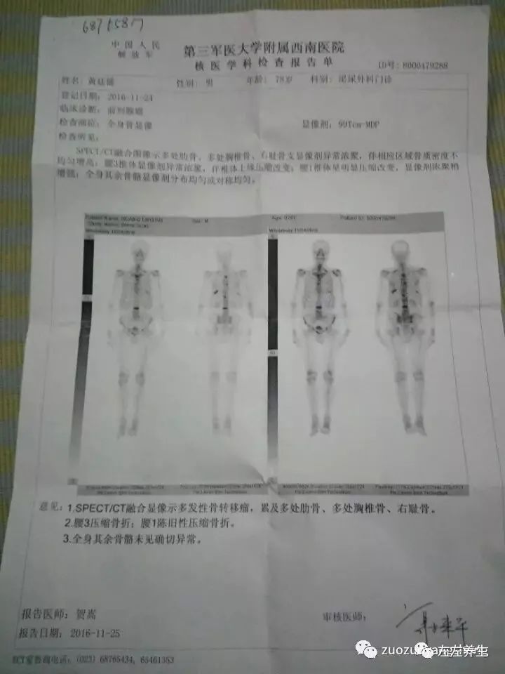 案例分享：前列腺癌的调理案例