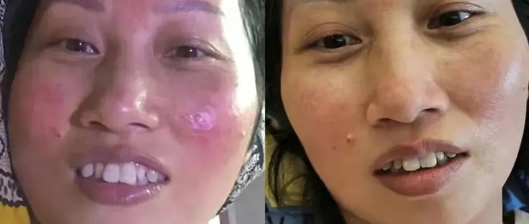 案例分享：脸上玫瑰痤疮调理案例-原始点全球同学网