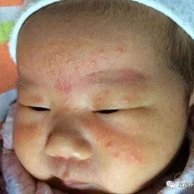 婴幼儿湿疹怎么办？（附手法视频）-原始点全球同学网