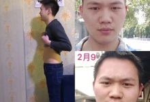 案例分享:刘老师十几年手足换季长水痘调理案例-原始点全球同学网