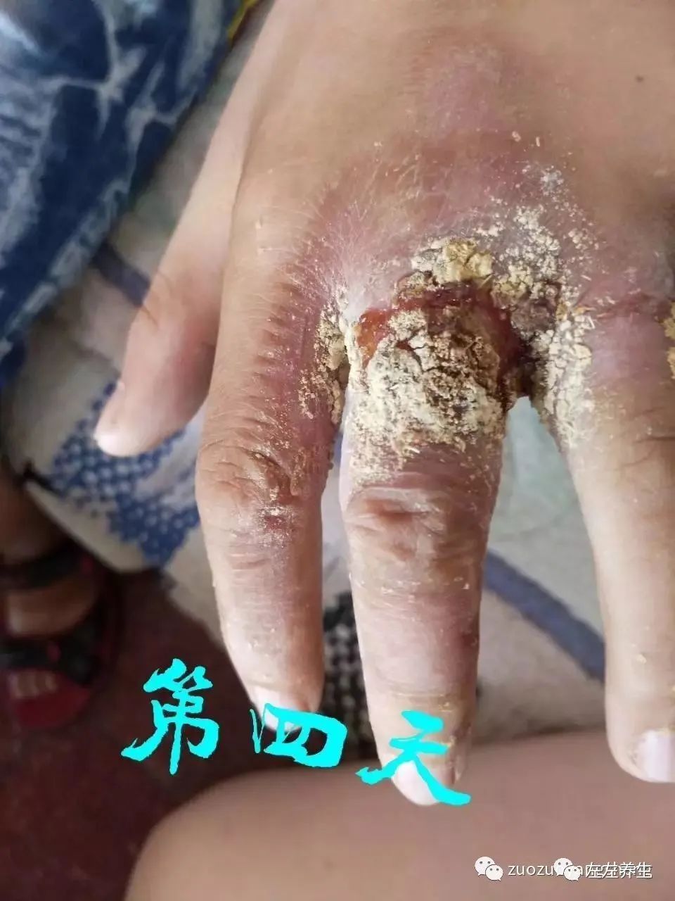 案例分享:小朋友手部烫伤调理案例 案例分享:小朋友手部烫伤调理案例