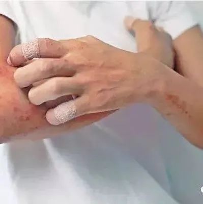 微问答76期：孩子身上反复起疹子怎么办？-原始点全球同学网