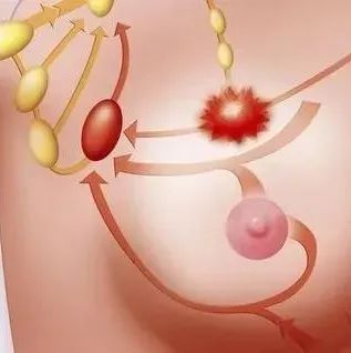 微问答119期：乳腺结节，手术切除是不是更好些？-原始点全球同学网