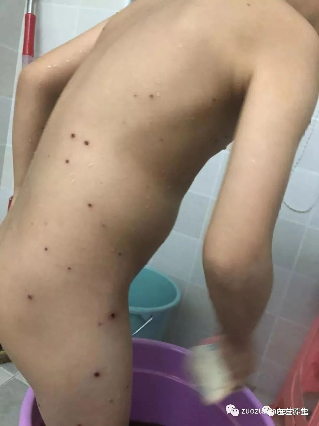 案例分享:5岁小孩水痘调理案例 案例分享:5岁小孩水痘调理案例