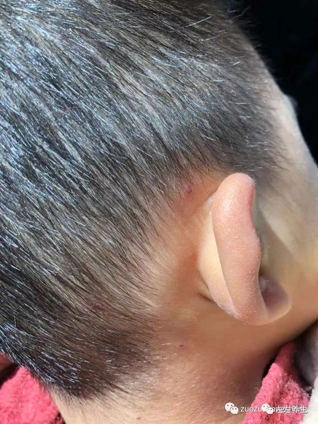 案例分享:小孩水痘以及右腿扭伤无法下地调理案例 案例分享:小孩水痘以及右腿扭伤无法下地调理案例