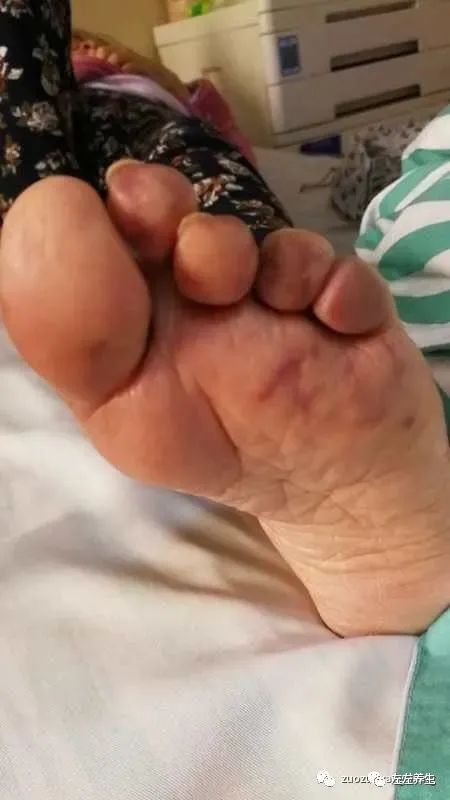 微问答83期:22岁开颅术手后偏瘫,现在癫痫发作需要药物控制,可以调理吗? 微问答83期:22岁开颅术手后偏瘫,现在癫痫发作需要药物控制,可以调理吗?