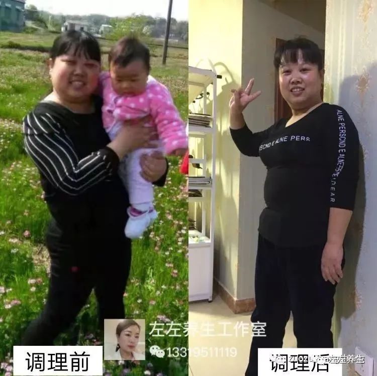 案例分享:肾病综合症(肾炎)调理案例 案例分享:肾病综合症(肾炎)调理案例