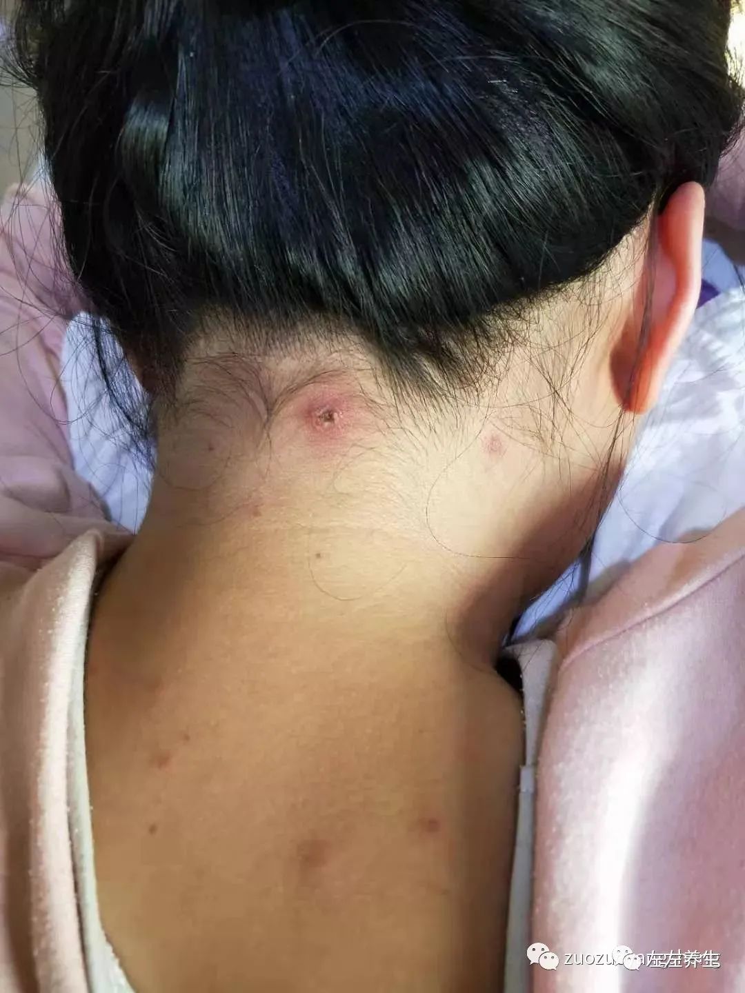 案例分享:成人水痘调理案例 案例分享:成人水痘调理案例
