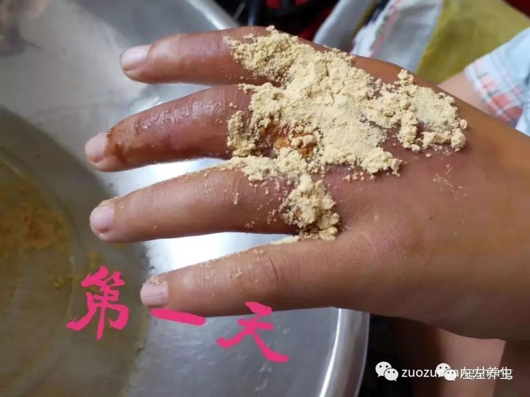 案例分享:小朋友手部烫伤调理案例 案例分享:小朋友手部烫伤调理案例
