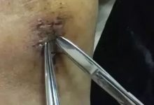 最难度的家人——原始点调理妈妈骨折手术后的康复-原始点全球同学网