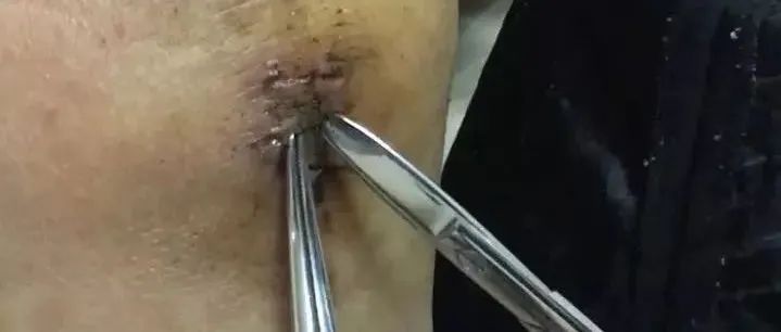 最难度的家人——原始点调理妈妈骨折手术后的康复-原始点全球同学网