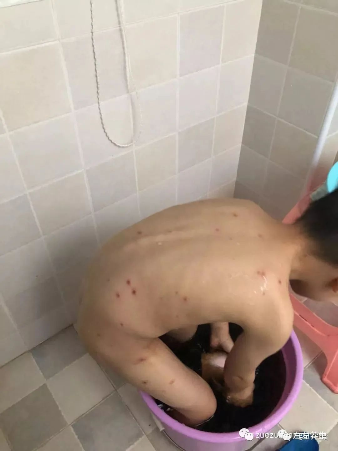 案例分享:5岁小孩水痘调理案例 案例分享:5岁小孩水痘调理案例