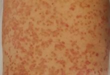 二十多年牛皮癬-原始點全球同學網