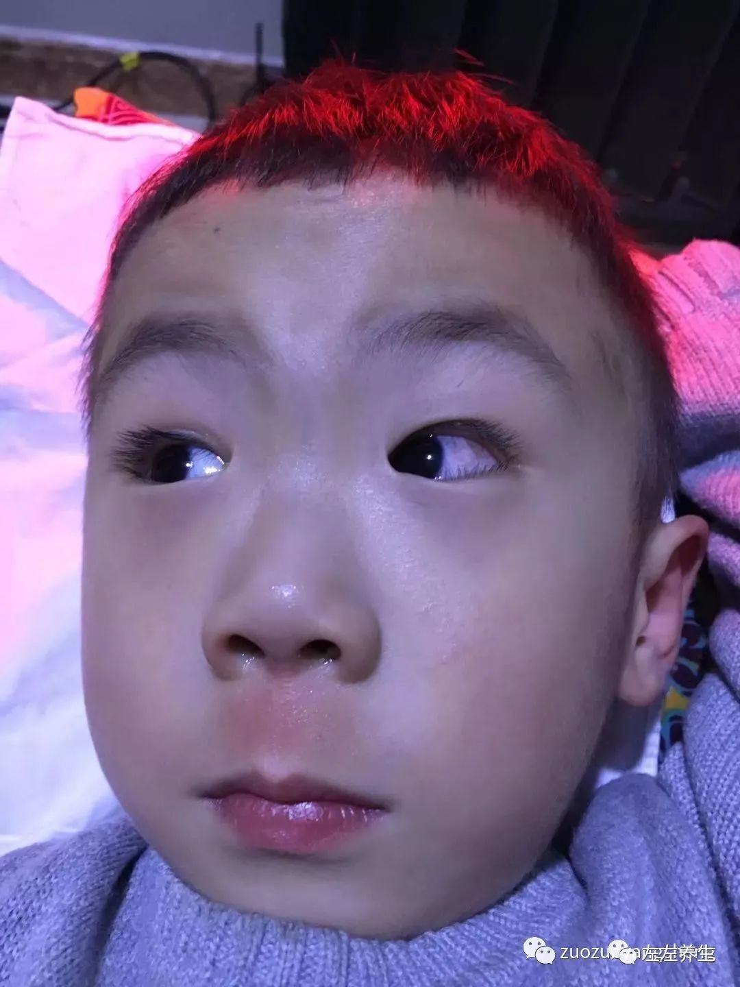 4岁小孩角膜炎调理案例 4岁小孩角膜炎调理案例