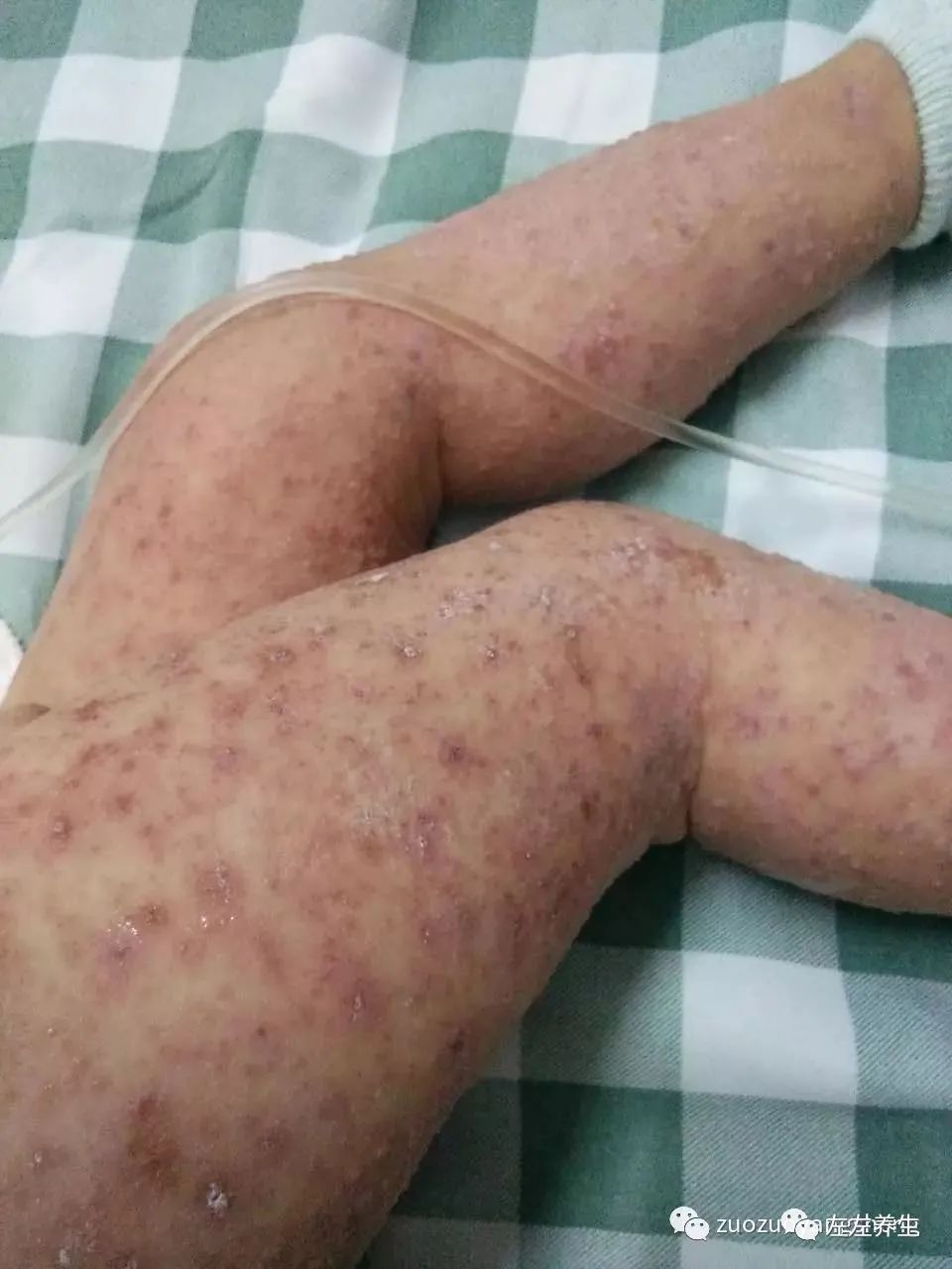 案例分享:小孩咳嗽后出现严重好转反应 案例分享:小孩咳嗽后出现严重好转反应