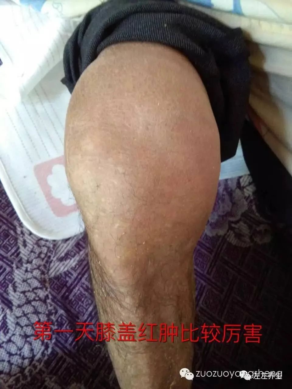 案例分享：类风湿腿痛调理五天改善案例