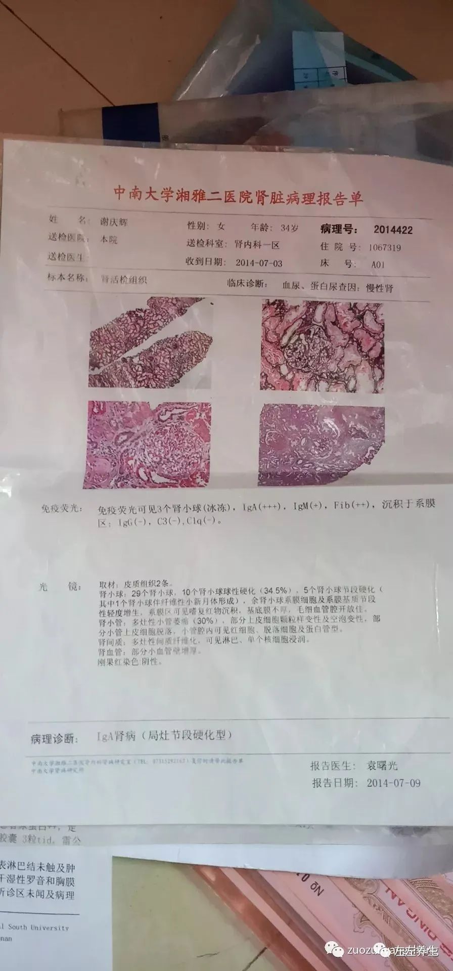 案例分享:肾病综合症(肾炎)调理案例 案例分享:肾病综合症(肾炎)调理案例