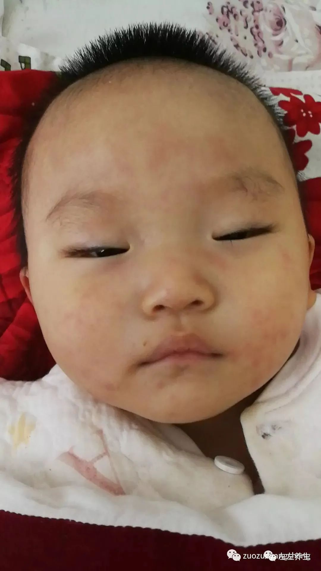 案例分享:周岁小孩持续高烧、频繁惊厥案例 案例分享:周岁小孩持续高烧、频繁惊厥案例