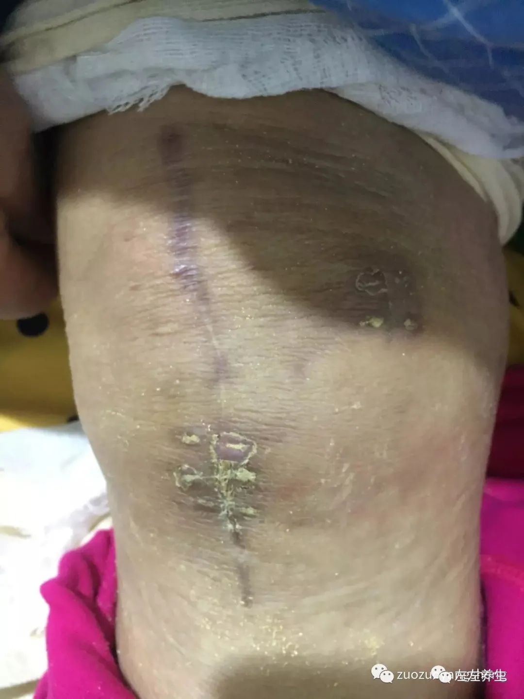 最难度的家人——原始点调理妈妈骨折手术后的康复