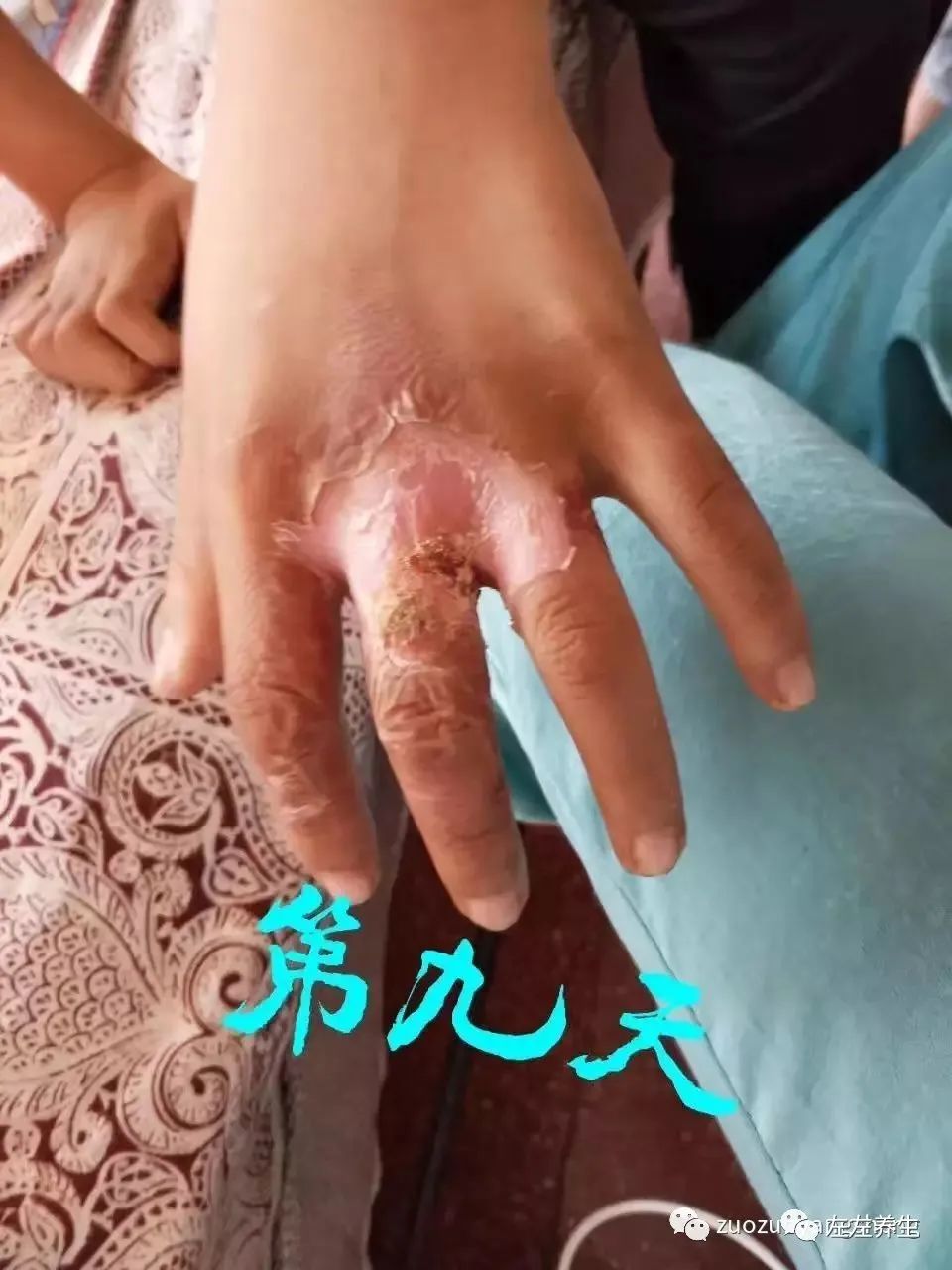 案例分享:小朋友手部烫伤调理案例 案例分享:小朋友手部烫伤调理案例