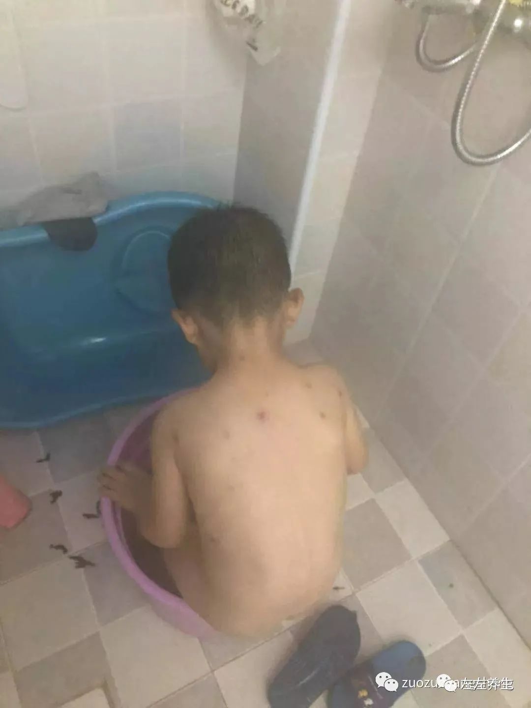 案例分享:小孩水痘以及右腿扭伤无法下地调理案例 案例分享:小孩水痘以及右腿扭伤无法下地调理案例