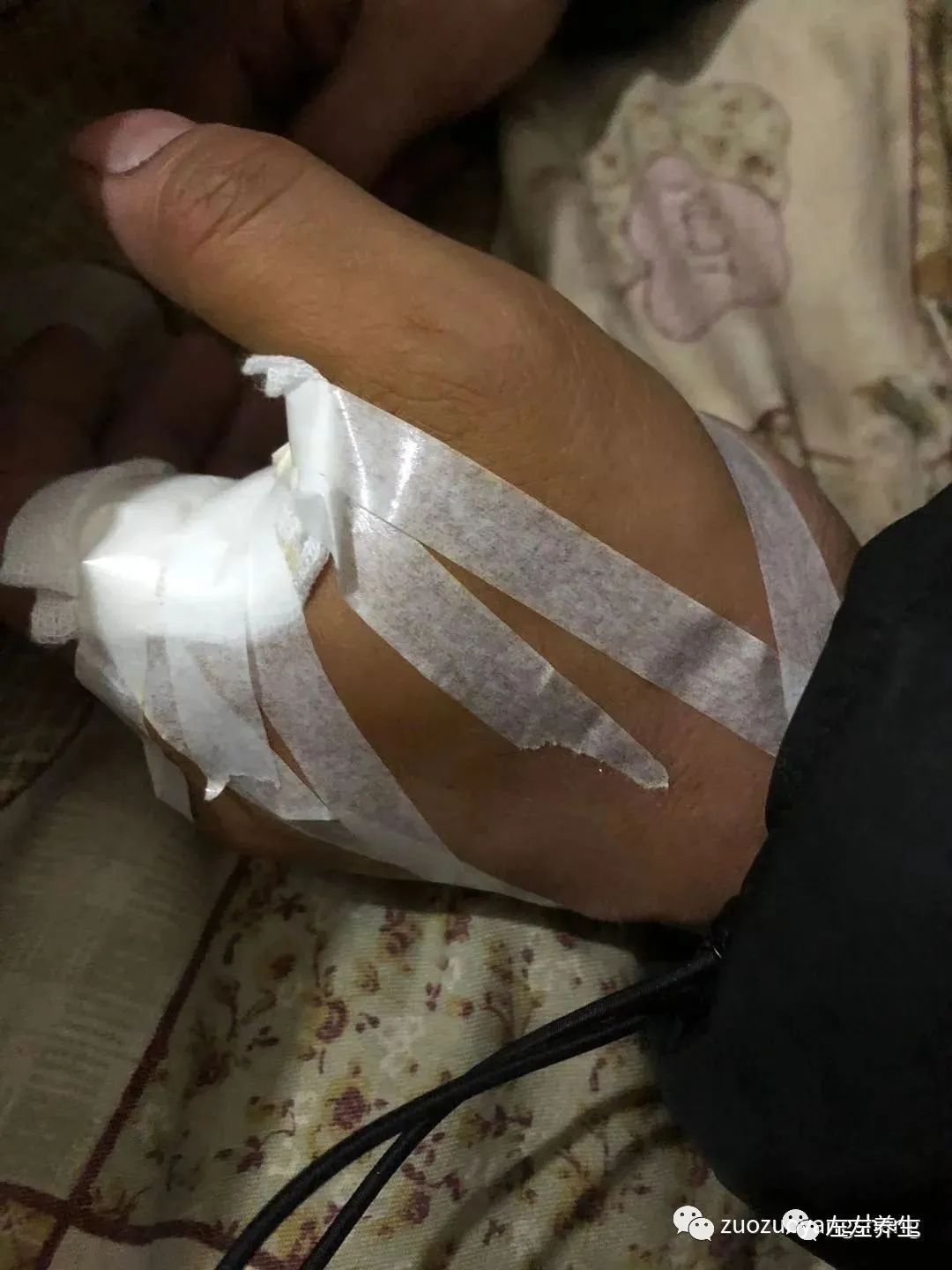 微问答122期：虎口被剪刀扎伤后，医生预判肌肉与经络严重受损可能需要手术……