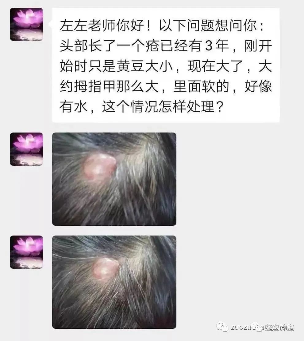 微问答54期:头上长了很大一个疮,里面软、有水,怎么处理? 微问答54期:头上长了很大一个疮,里面软、有水,怎么处理?