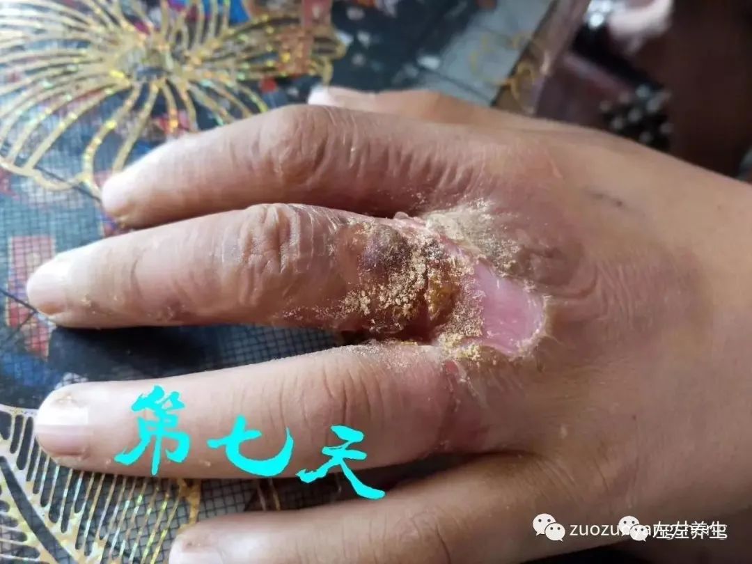 案例分享:小朋友手部烫伤调理案例 案例分享:小朋友手部烫伤调理案例