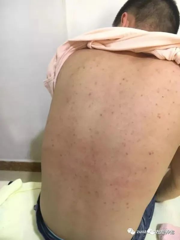 强制性脊柱炎调理案例 强制性脊柱炎调理案例