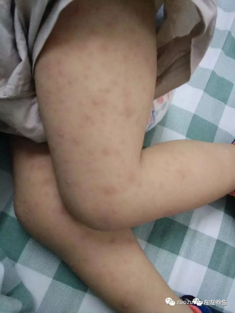 案例分享:小孩咳嗽后出现严重好转反应 案例分享:小孩咳嗽后出现严重好转反应