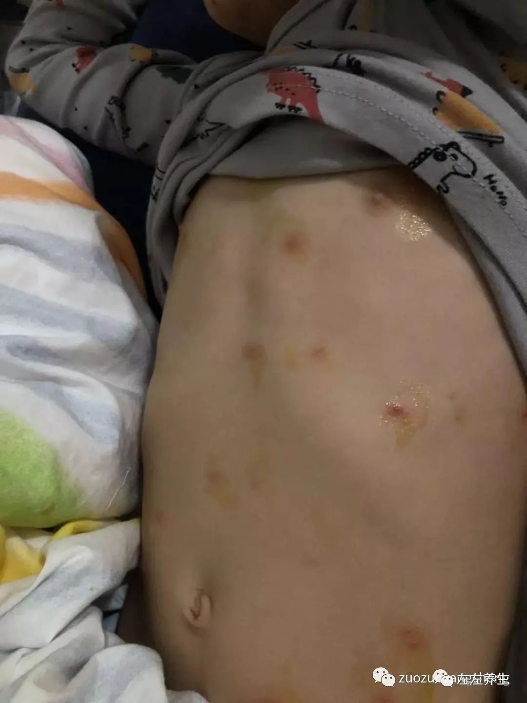 案例分享:5岁小孩水痘调理案例 案例分享:5岁小孩水痘调理案例