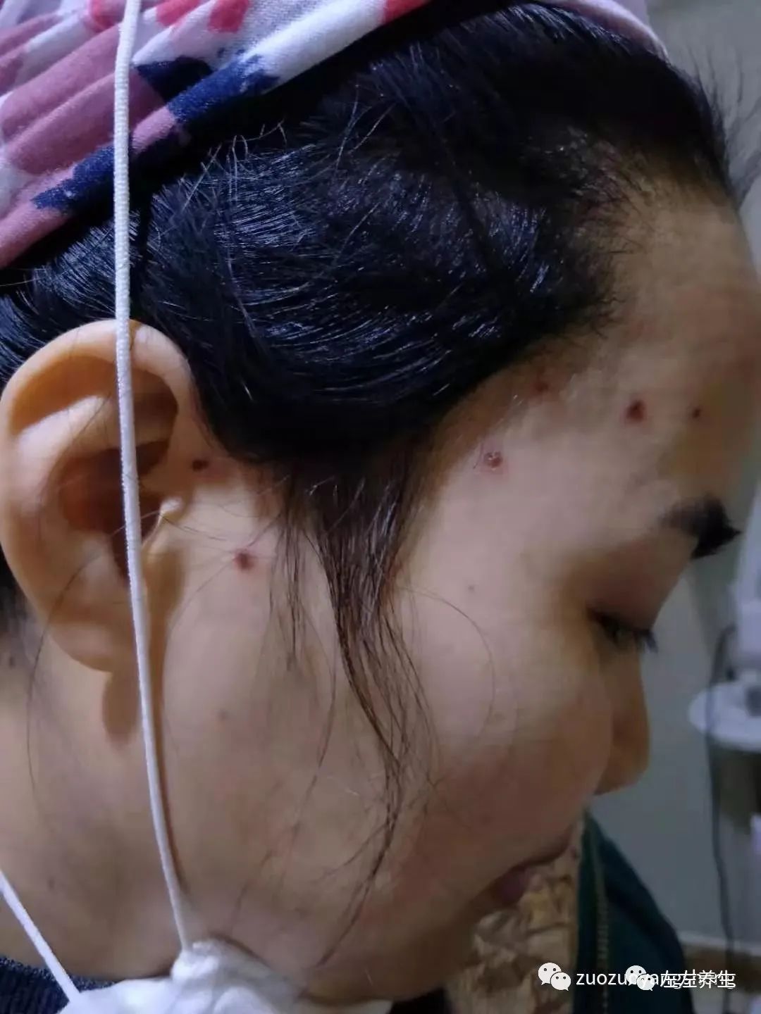 案例分享:成人水痘调理案例 案例分享:成人水痘调理案例