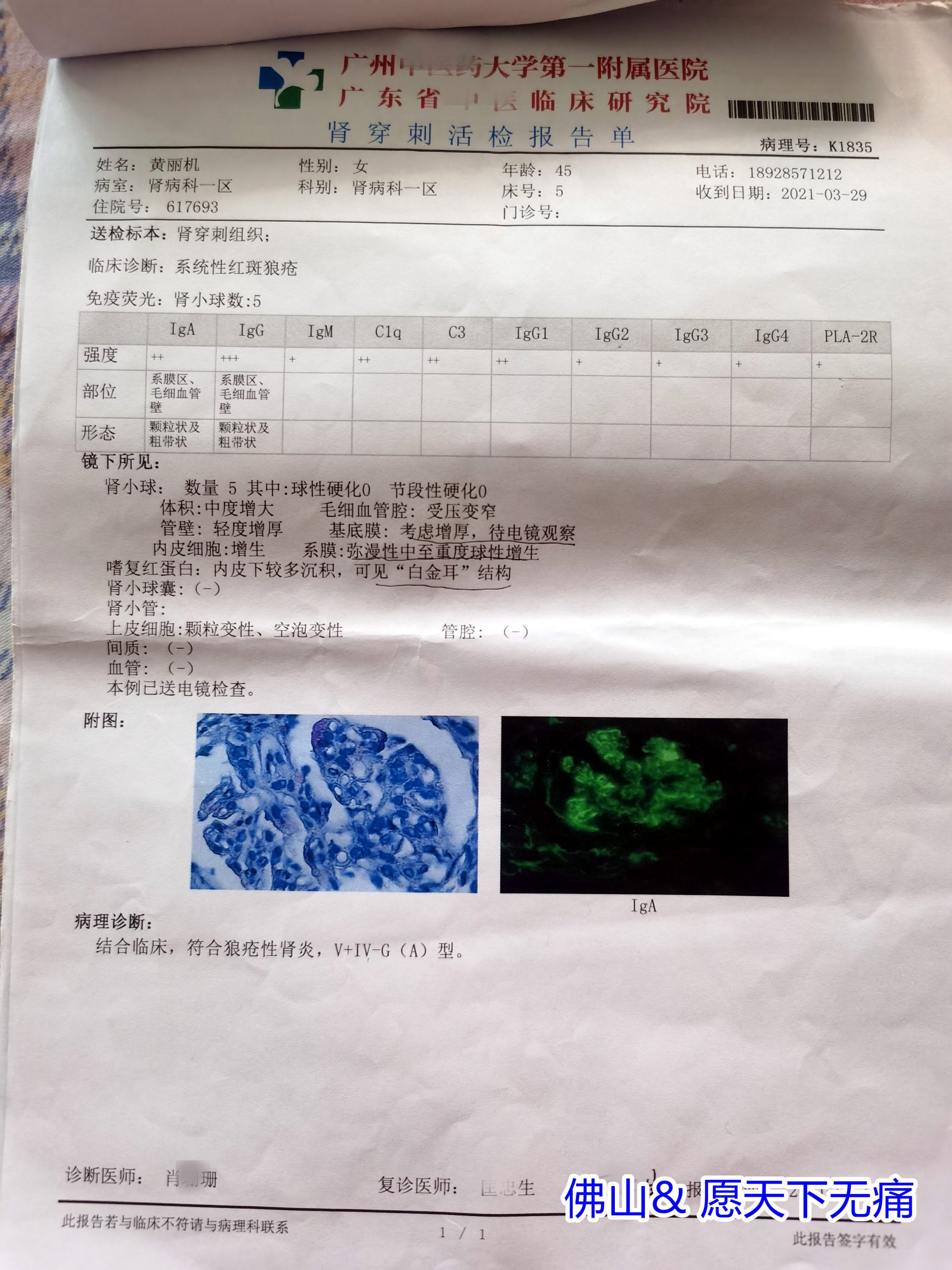 原始点调理红斑性狼疮及治疗后引发并发症案例 - 皮肤 - 佛山愿天下无痛