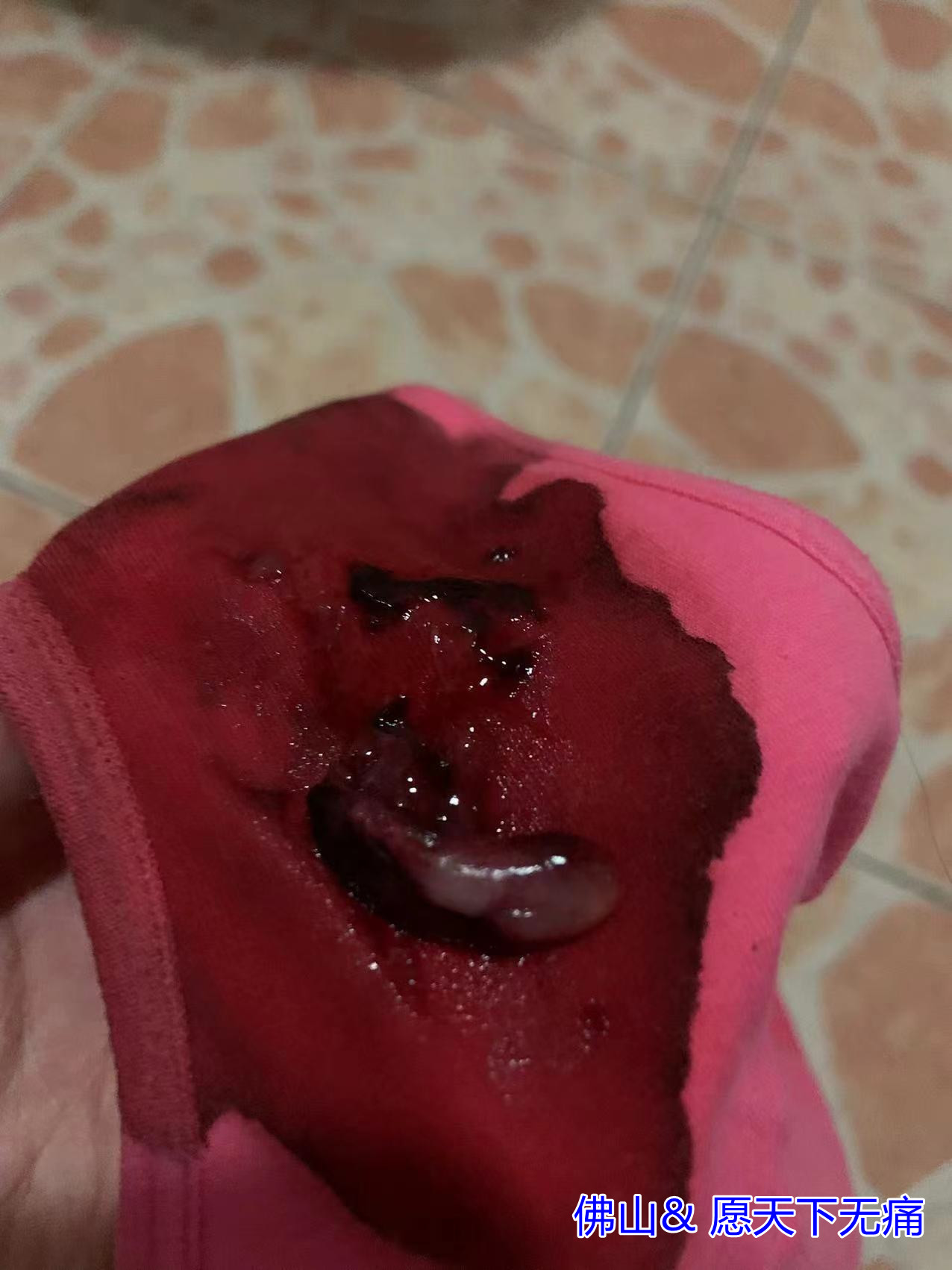 原始点调理胎死腹中 两天排出案例 - 妇女  - 佛山愿天下无痛