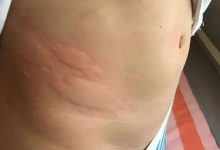 案例分享:小孩疑似荨麻疹调理案例-原始点全球同学网