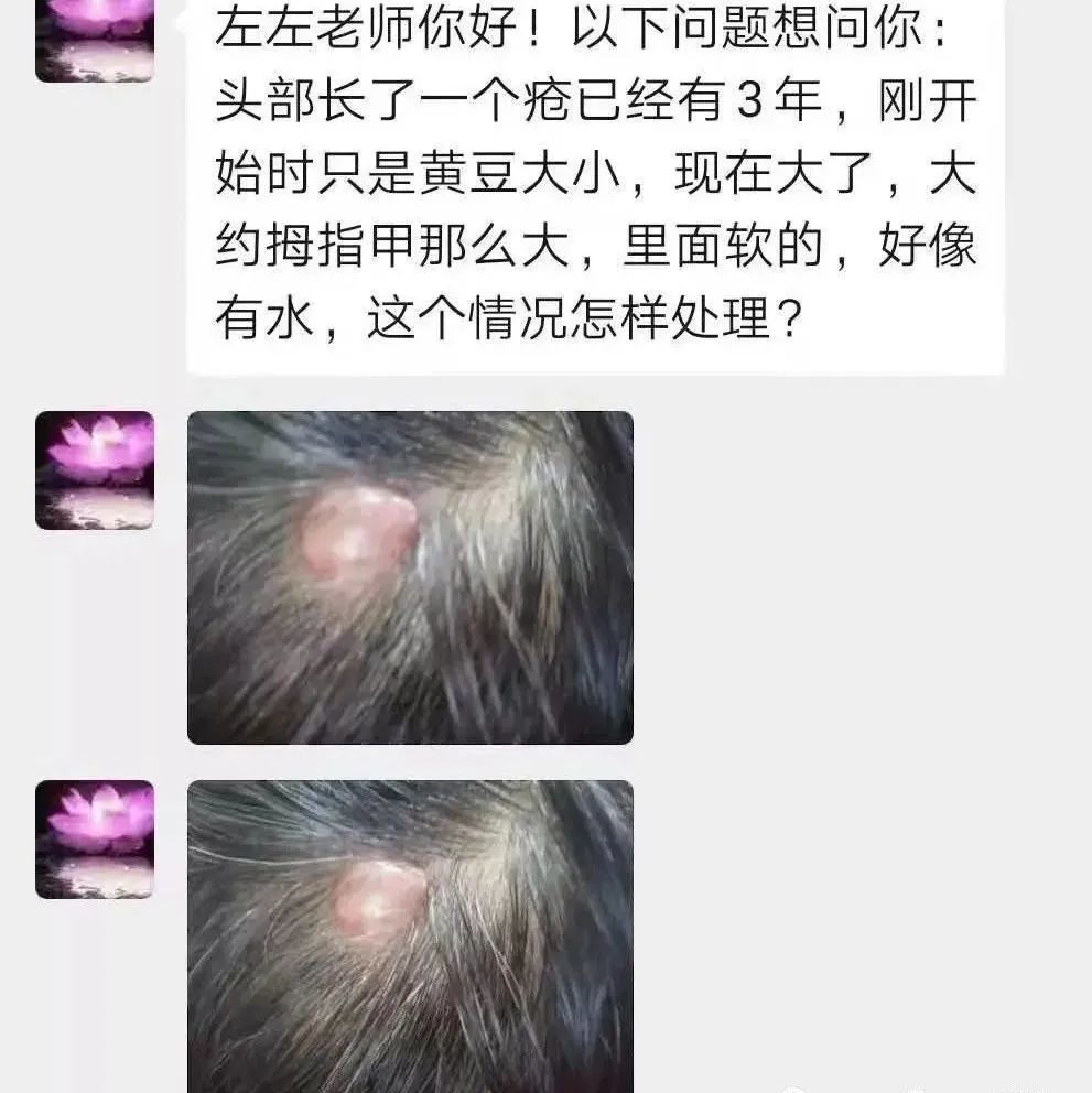 微问答54期：头上长了很大一个疮，里面软、有水，怎么处理？-原始点全球同学网