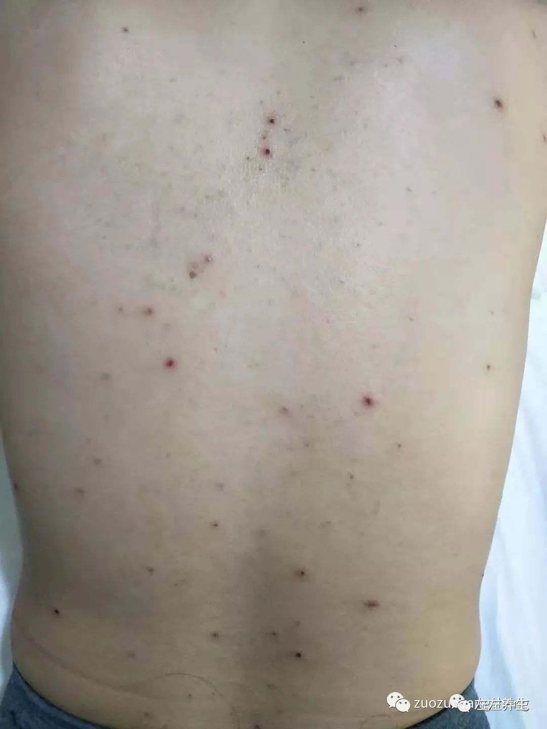 案例分享:成人水痘调理案例 案例分享:成人水痘调理案例