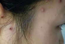 案例分享：成人水痘調理案例-原始點全球同學網