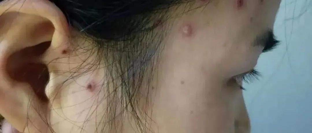 案例分享：成人水痘调理案例-原始点全球同学网