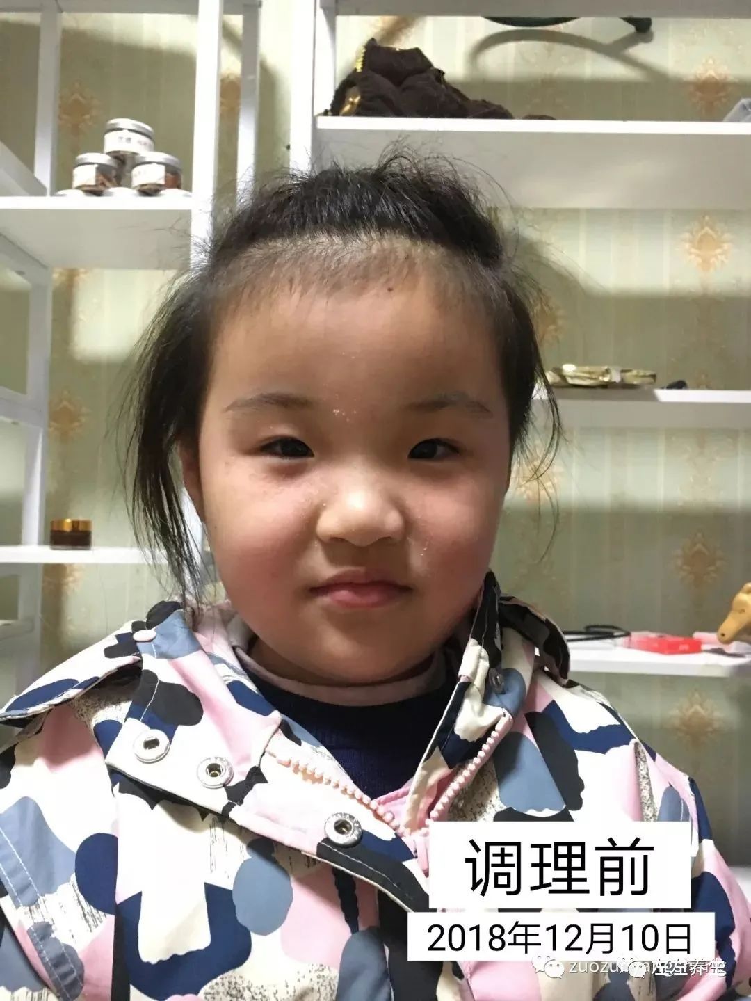 案例分享：摆脱打针吃药痛苦——两孩子哮喘、咳喘、湿疹、鼻塞、体质弱调理案例