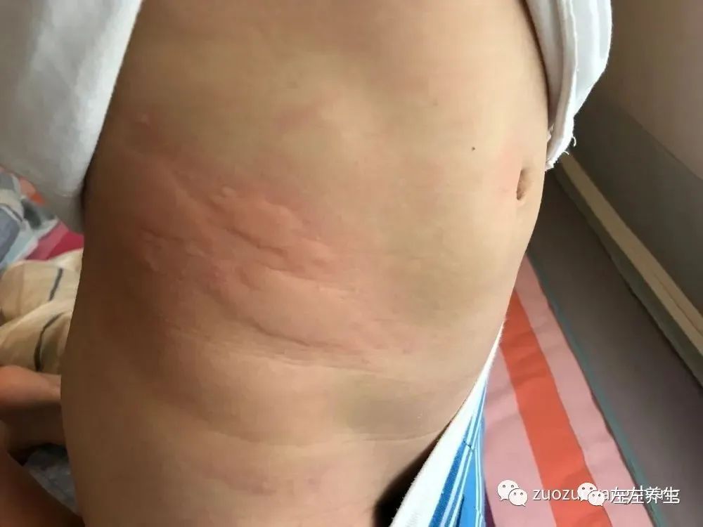 小孩疑似荨麻疹调理案例 小孩疑似荨麻疹调理案例