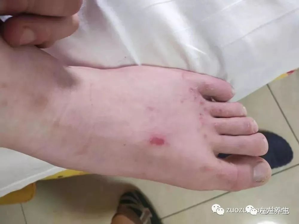 案例分享:刘老师十几年手足换季长水痘调理案例 案例分享:刘老师十几年手足换季长水痘调理案例