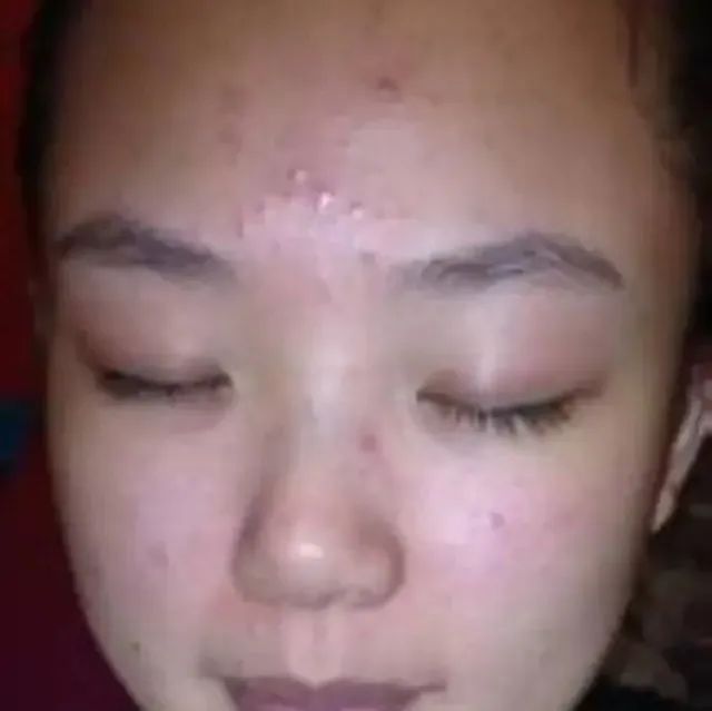 案例分享：严重青春痘和溢脂性皮炎调理案例-原始点全球同学网