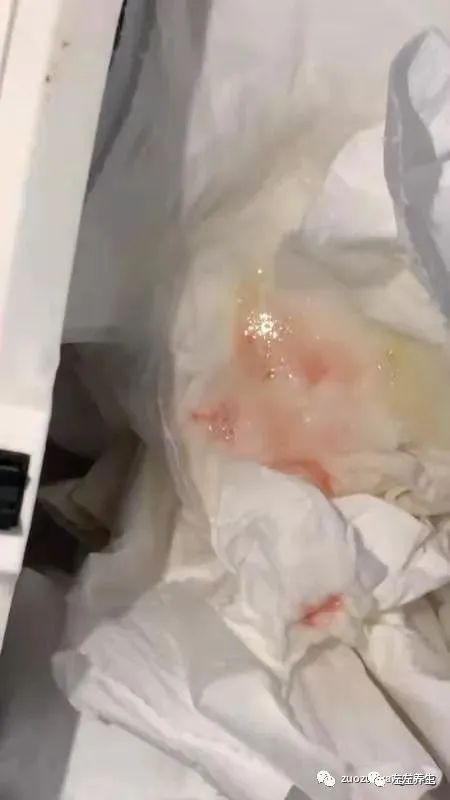 小孩咳血调理两次见效案例 小孩咳血调理两次见效案例