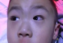 案例分享:4岁小孩角膜炎调理案例-原始点全球同学网