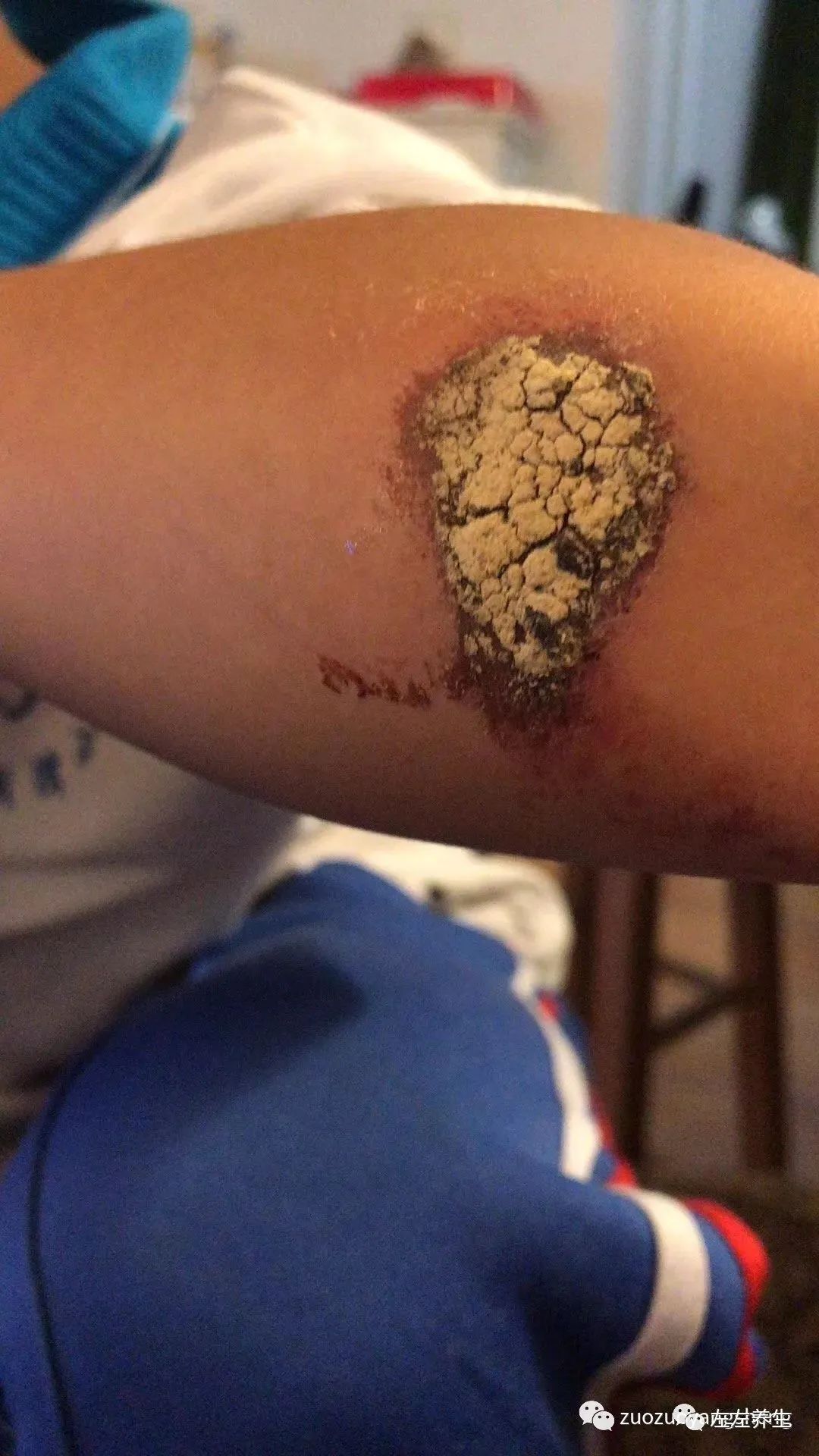 4岁小孩角膜炎调理案例 4岁小孩角膜炎调理案例