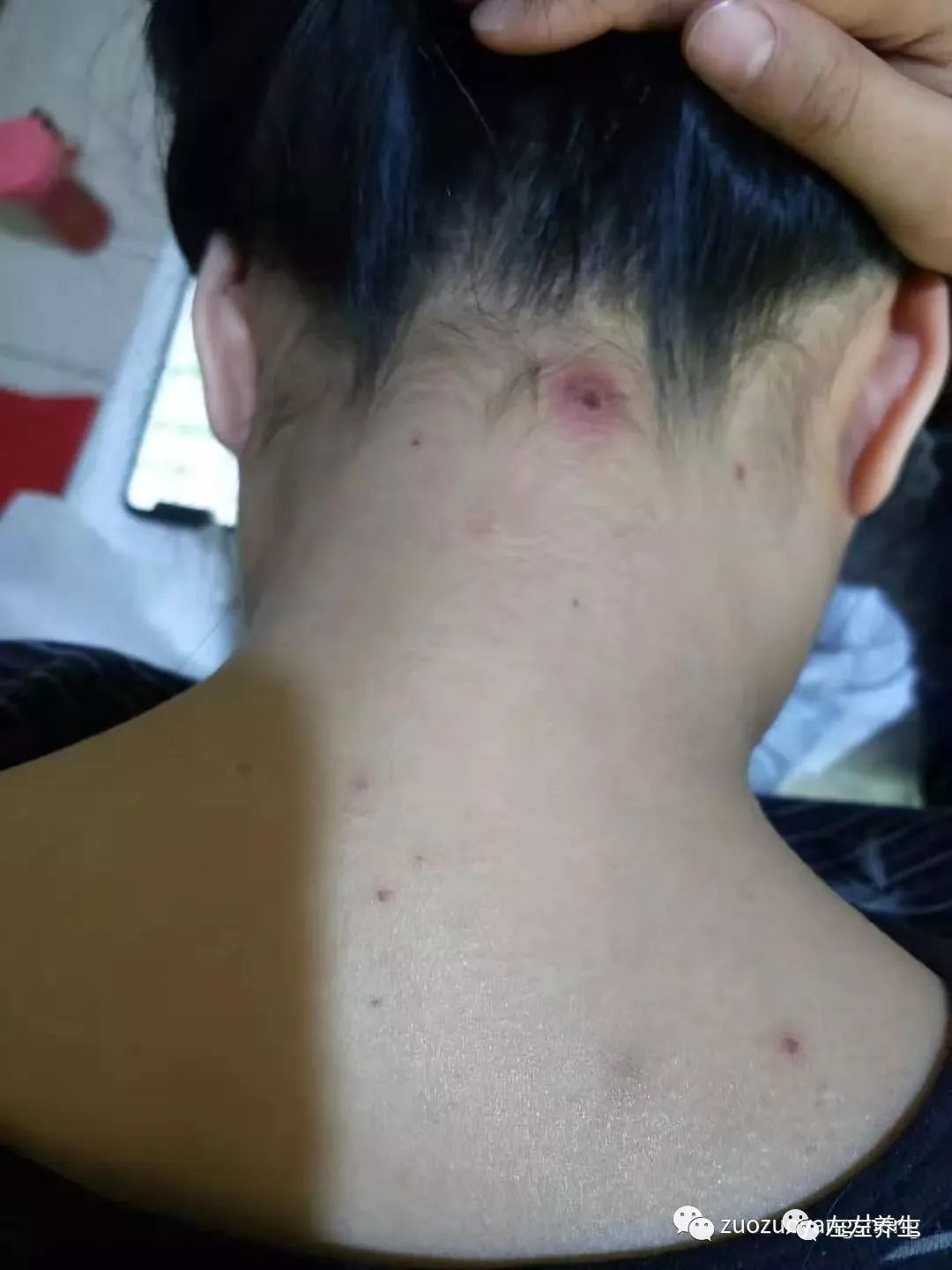 案例分享:成人水痘调理案例 案例分享:成人水痘调理案例