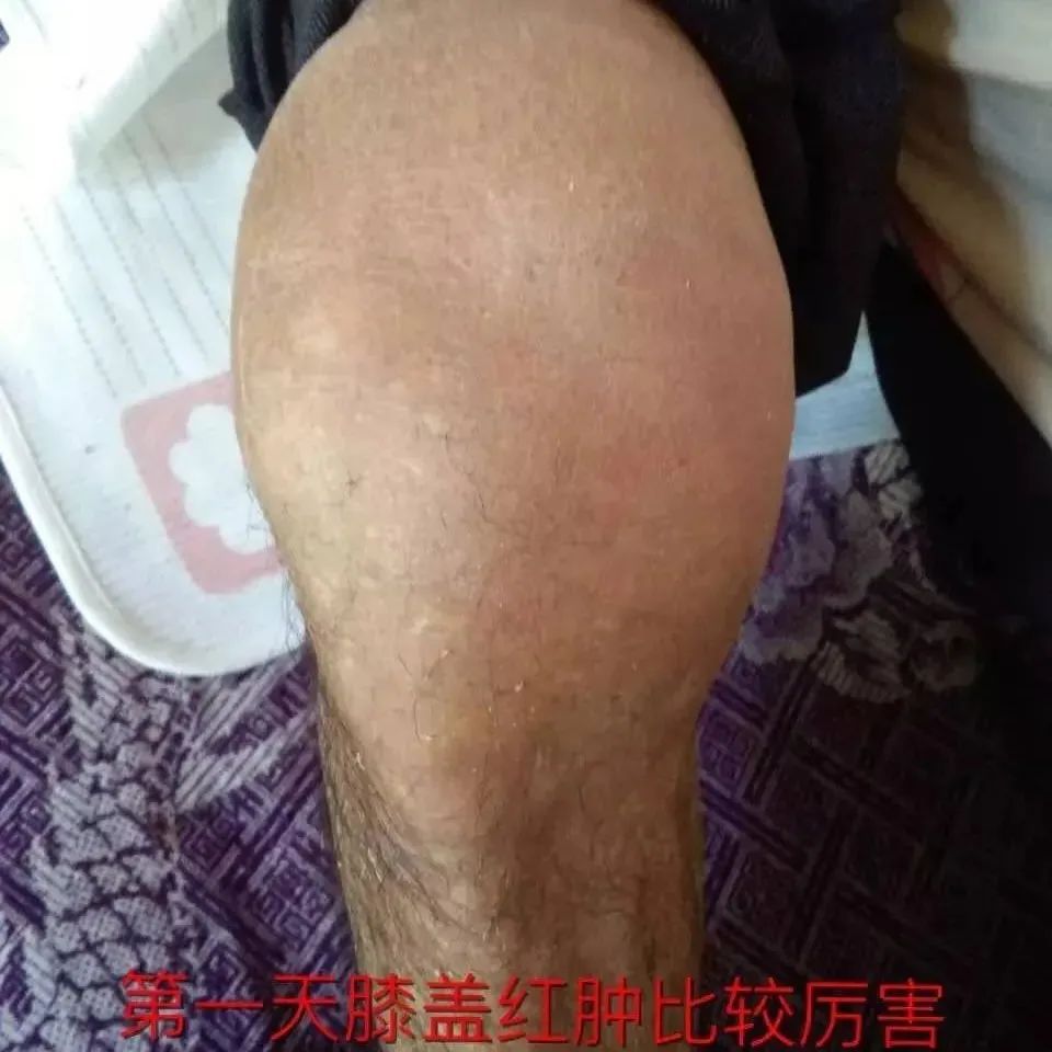 案例分享：类风湿腿痛调理五天改善案例-原始点全球同学网